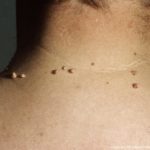 Skin Tags and Skin Growths