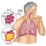 Pneumonia in rosendale and highland