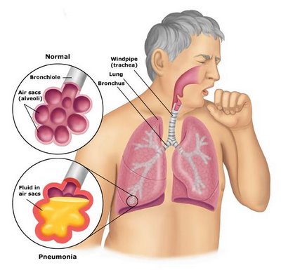pneumonia doctors