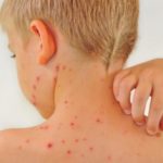childhood and kids rashes in new paltz and highland