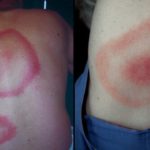 Lyme Disease and Lyme Rash