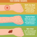 Tick Borne Illness such as Bartonella and Lyme Disease